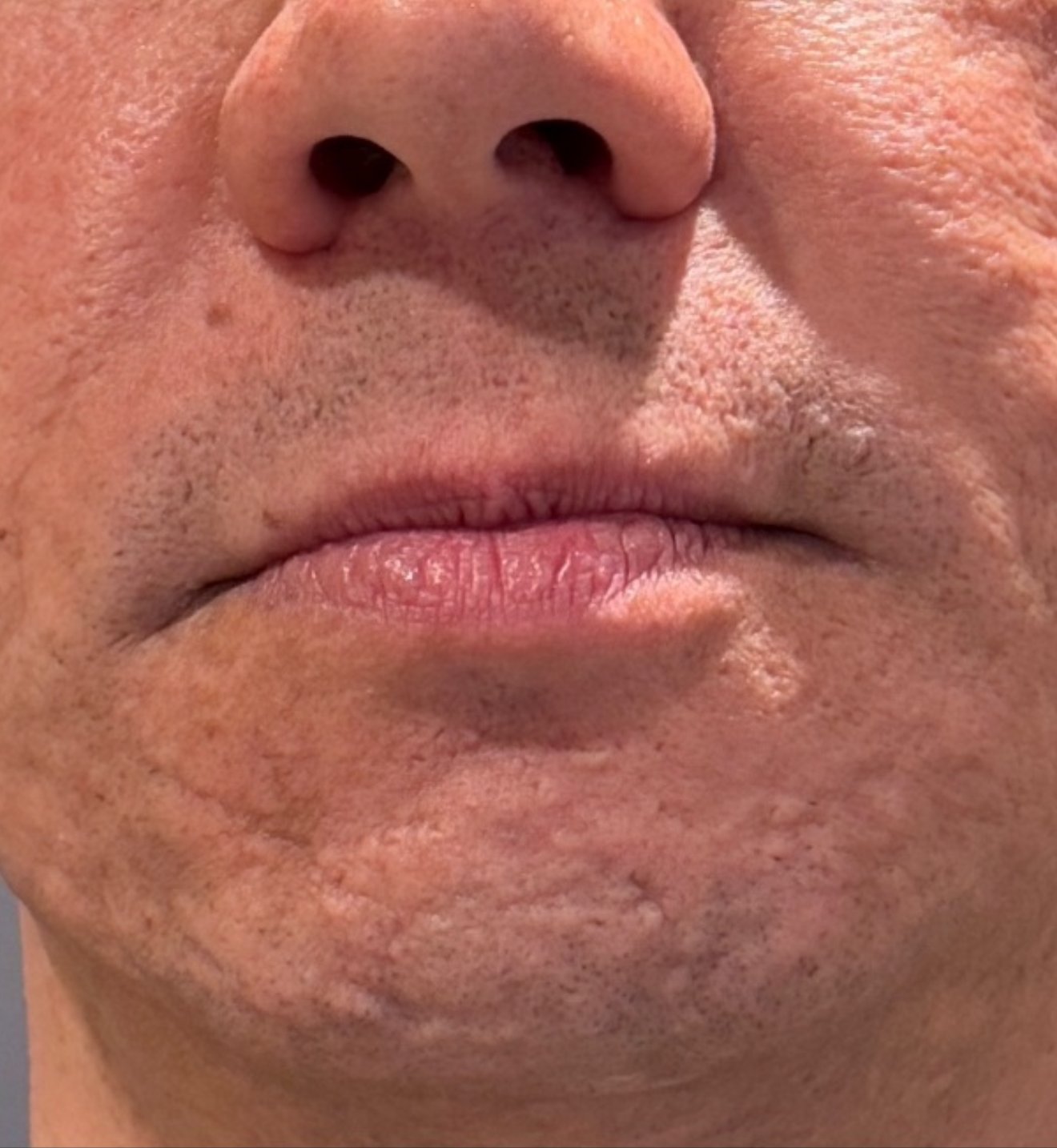 Skin 60 days after two Alma Hybrid fractional CO2 laser treatments