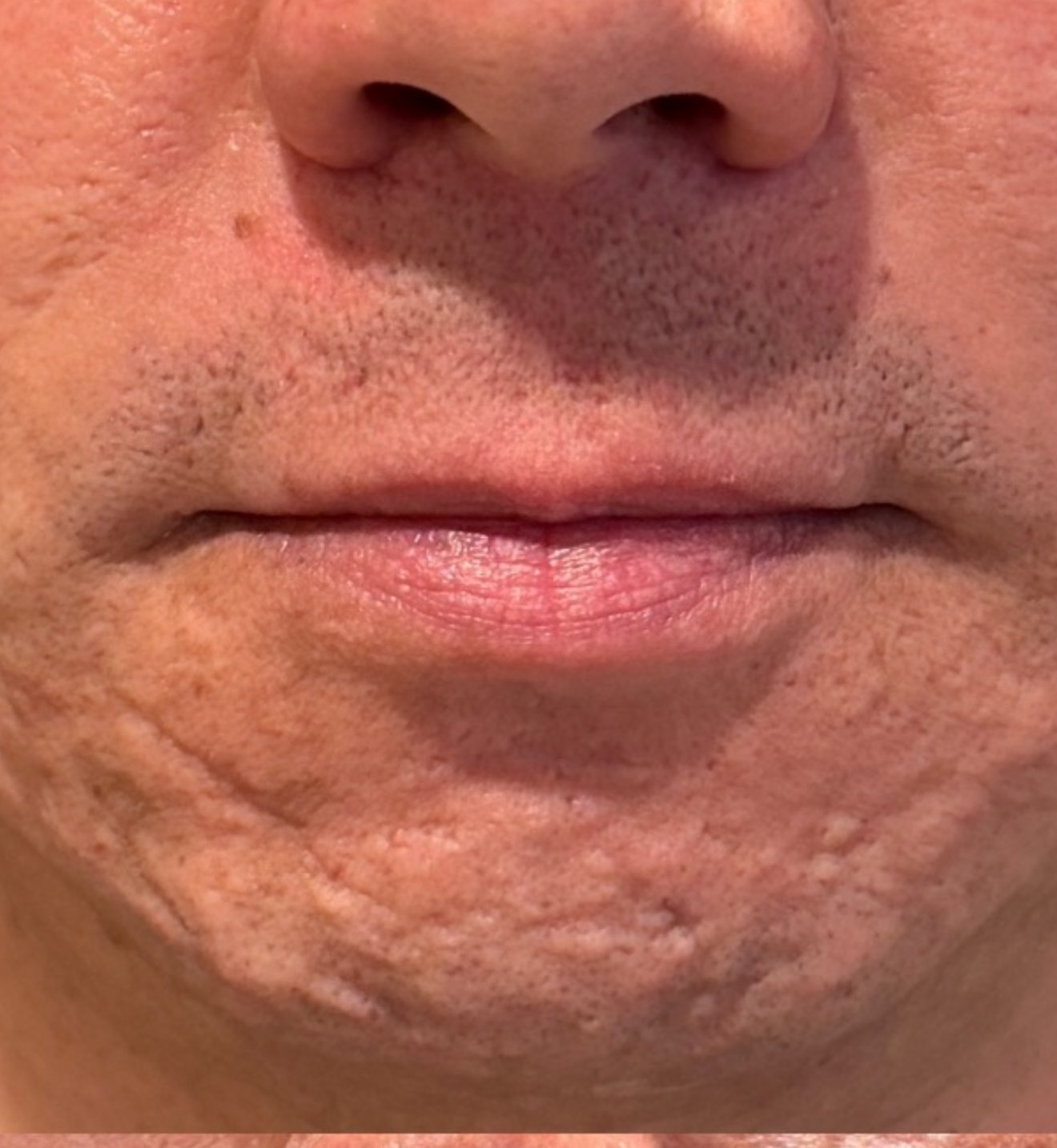 Skin before Alma Hybrid fractional CO2 laser resurfacing